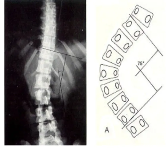 Fig. 1. Cobb's angle 2.4 복부근지구력측정 복부근지구력은  대상자가  바닥에  누운  상태에서  보조 자가  다리를  고정하여  무릎을  직각으로  구부린  후,  상체 를  일으켜  팔꿈치가  무릎에  닿고  다시  누운  상태로  되돌 아가면  1회로  간주하여  그  횟수를  30초간  측정하였다