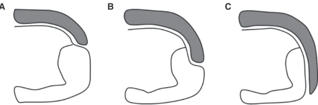 Fig. 5. The design of PLV preparation on tooth with class  III composite filling (A), tooth with class IV cavity (B)