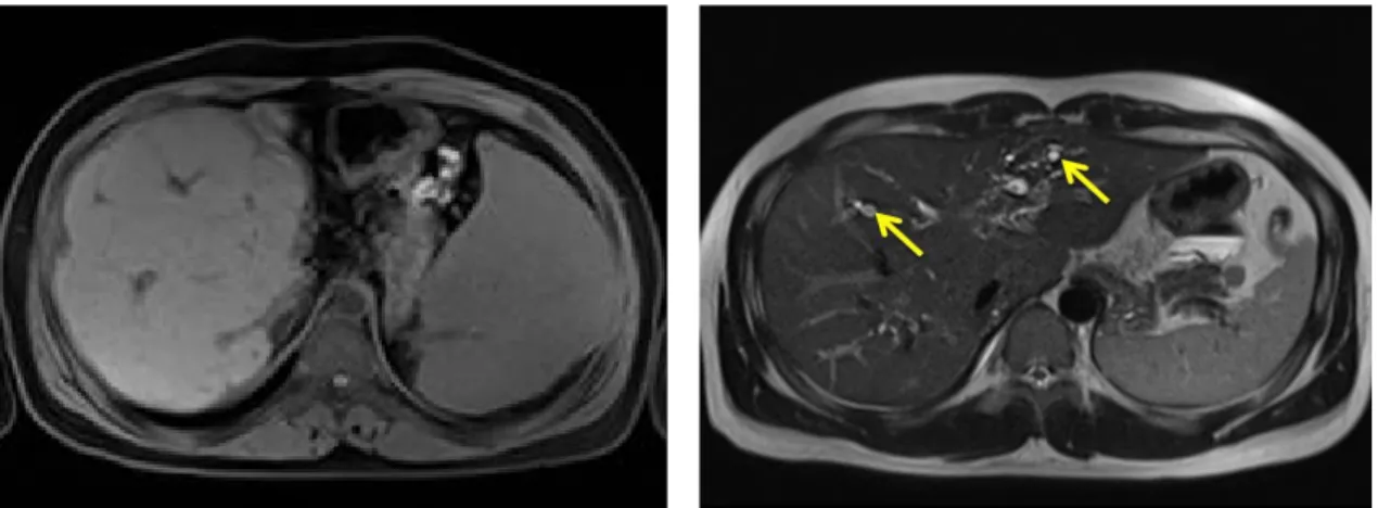 Fig.  1.  Findings  of  macroregenerative  nodule  and  beaded  duct  appearance  in  MRI
