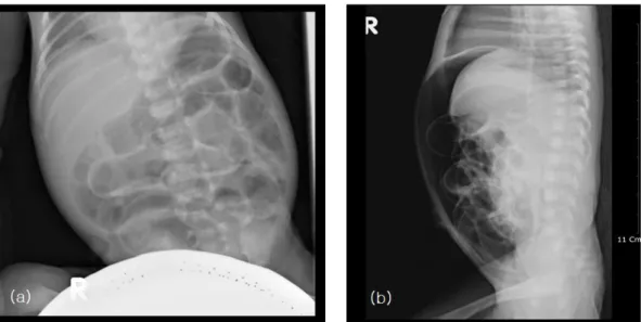 Fig.  1.  Preoperative  supine(a)  and  cross-table  lateral(b)  abdominal  X-ray  show  distension  of  bowel  loops  and  free  air  in  the  peritoneum.