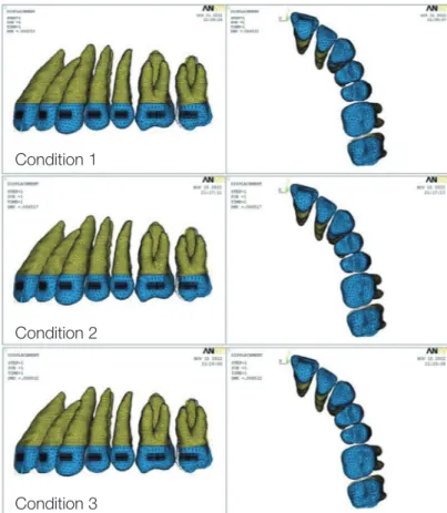 Fig. 3. Displacement pattern of second molar (200 times magnified). Dotted mesh, before displacement; Colored mesh,  after displacement.