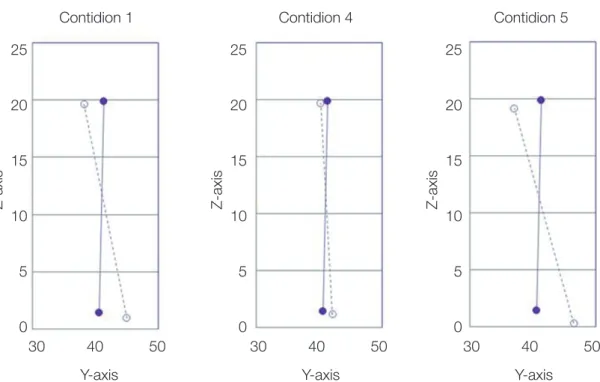 Table 2와 Fig. 6, 7을 보면 Condition 4에서는 Condition  1에 비해서, 제2대구치의 원심 변위량, 원심 경사 경 향, 정출 방향 수직 변위량, 그리고 mesial out rotation 과 함께 외측으로 넓어지는 양상 모두 감소하였다