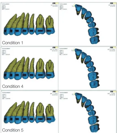 Fig. 7. Displacement pattern of second molar (200 times magnified). Dotted mesh, before displacement; Colored mesh,  after displacement.