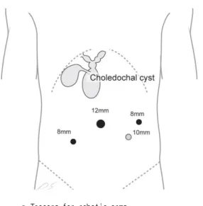 Fig.  1.  The  12-mm  camera  port  was  inserted  at  supraumbilical  area.  Two  8-mm  working  ports  were  selected  based  on  the  size  of  patients  and  the  location  of  cyst  under  viewing  of  the  peritoneal  cavity