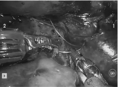 Fig.  2.  Three-dimensional  image  of  hepaticojejunostomy  using  robotic  arms  with  5-0  Vicryl  interrupted  sutures  after  resection  of  choledochal  cyst.