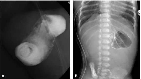 Fig.  1.  Serial  chest  PA  and  simple  abdominal  X-rays.  A.  Three  days  after  corrective  esophageal  surgery  shows  normal  pattern  of  bowel  gas