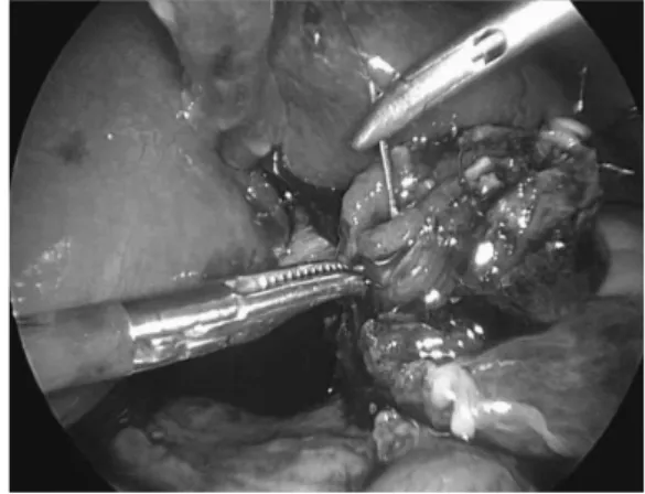 Fig. 4. Left hand with grasper hold  duodenum and hypertrophic pyloric  muscles were split with pyloric spreader  (arrow)