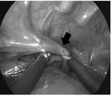 Fig 6. The neonate was prone  position with right side 45  degree elevation. One 5 mm port  was placed at tip of scapula for  camera and two 3 mm ports for 