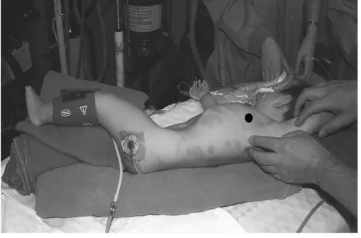 Fig. 8. The neonate was supine position and 5 mm camera port ( ● )  was  placed at anterior axillary line.