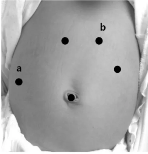 Fig. 9. Laparoscopic fundoplication  need 5 ports; liver retraction (a),  camera  (b), and 3 forceps