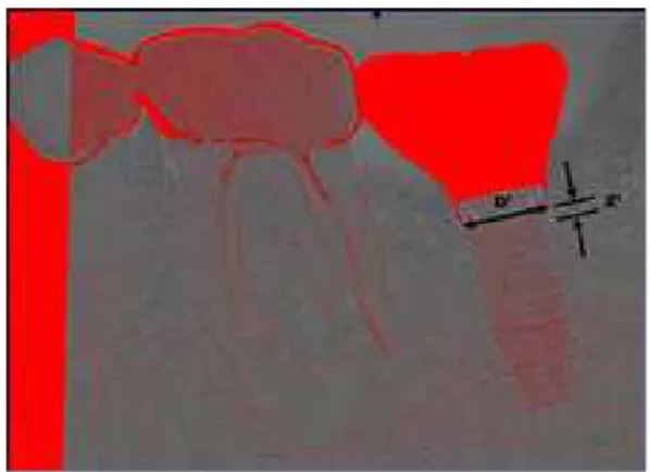 Fig. 1. References used to measure the actual marginal bone loss.