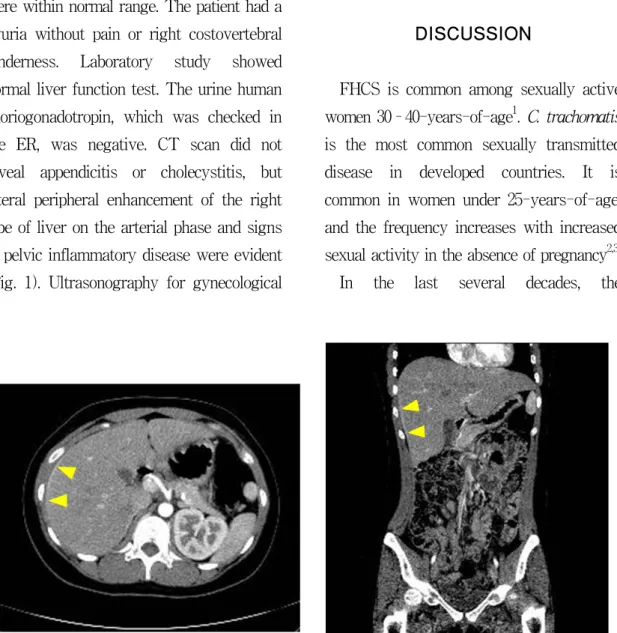 Fig. 1. CT scan showing lateral peripheral enhancement of the right liver and signs of PID  (arrowhead)