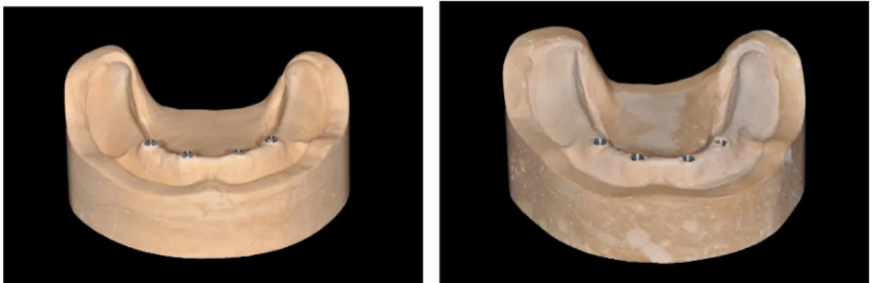 Fig. 3. Master model made from a pick up impression of the superstructure (a) external connection system (b) internal connection system