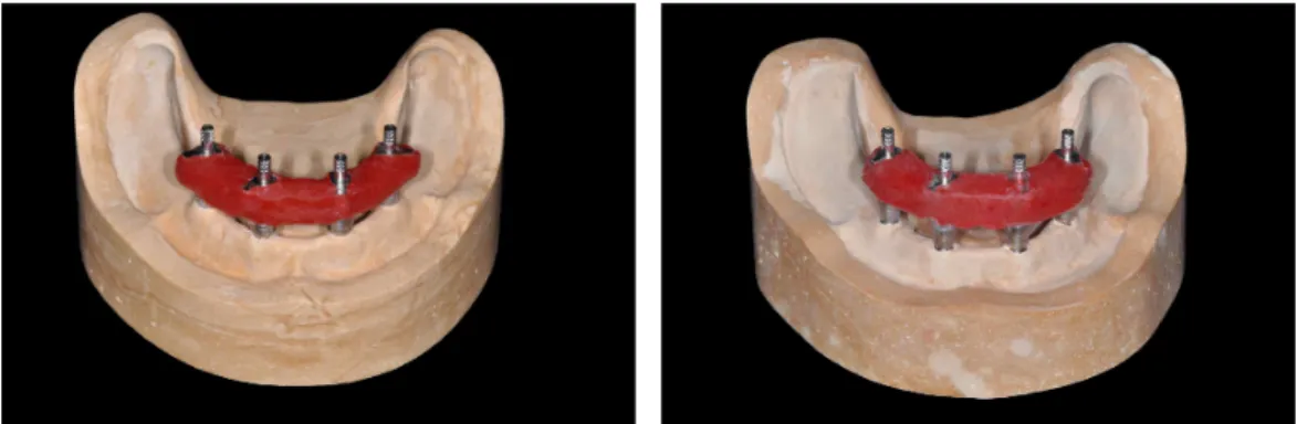 Fig. 4. Splinted pick up type impression copings