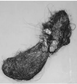 Fig. 4. Trichobezoar after removal.