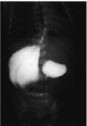 Fig. 2. Upper gastrointestinal series shows the stomach on the right side and the duodenum on the left side.
