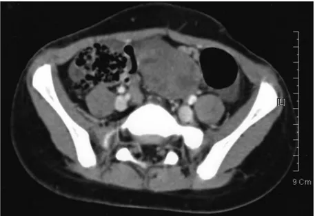 Fig. 2. Abdominal and pelvic CT scan shows a 5 × 3 cm sized  mass in the pelvic cavity.
