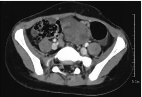 Fig. 2. Abdominal and pelvic CT scan shows a 5 × 3 cm sized  mass in the pelvic cavity.