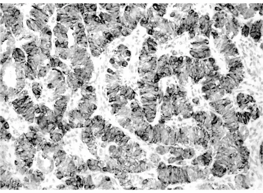 Fig. 5. Immunohistochemical stain is positive for inhibin(× 200).  