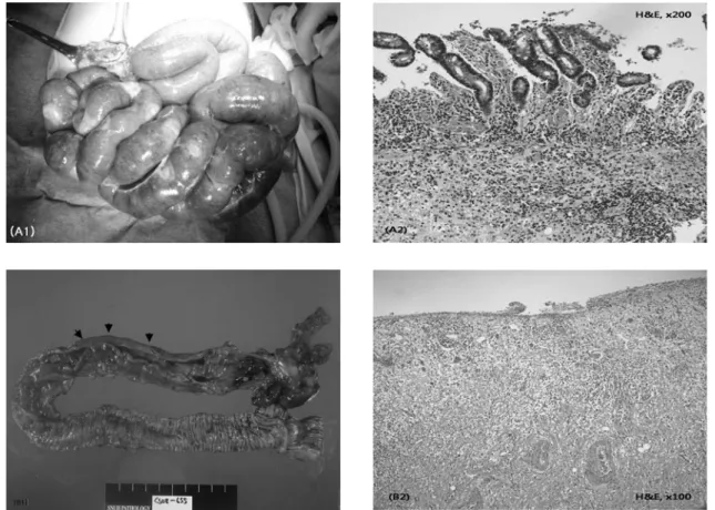 Fig. 1. Four different causes (A～D) of intestinal obstruction