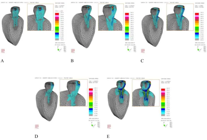 Table 4. Maximum von Mises stress in the bone, fixture, and screw (Unit; Mpa) Model Loading condition Location ModelABC D E Bone 10.28 27.63 32.88 17.24 106.30 Fixture 13.57 31.02 36.76 23.86 123.20 Screw 12.79 26.76 28.18 19.21 84.05