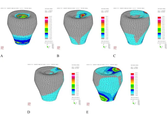 Fig. 8. The stress contour of the crown in model under loading condition A, B, C, D, E.