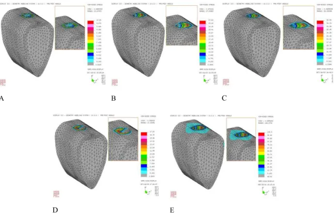 Fig. 10. The stress contour of the supporting bone in model under loading condition A, B, C, D, E.