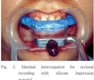Fig. 2. Maximal intercuspation for occlusal recording with silicone impression material