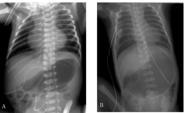 Fig. 1. Plain radiograms of a neonatal duodenal atresia, diagnosis of which was delayed
