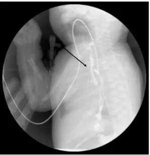 Fig. 1. Chest X-ray, showing the coiled  orogastric tube in the proximal esophagus  and stomach gas