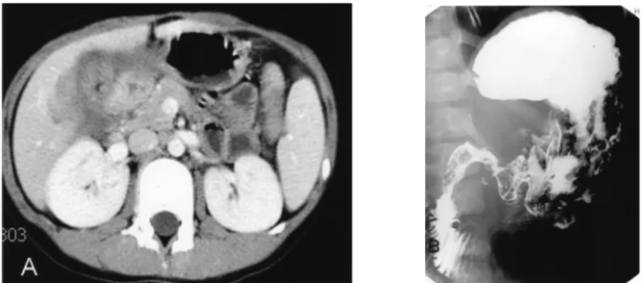 Fig. 2. (A) abdominal CT scan showing ill defined mass surrounding antrum of stomach,  duodenum, gall bladder, common hepatic duct, and porta hepatis with fluid collection  (B) upper gastrointestinal series showing luminal irregularity at the antrum of the