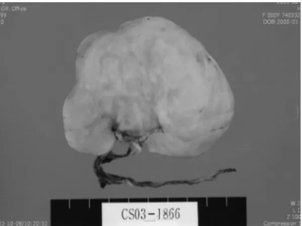 Fig. 3. Omental IMT: Gross finding of  surgical specimen: lobulation as well as  variegation of the cut surface