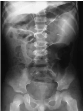 Fig. 1. Plain abdominal radiograph showing  marked colonic gaseous distension.