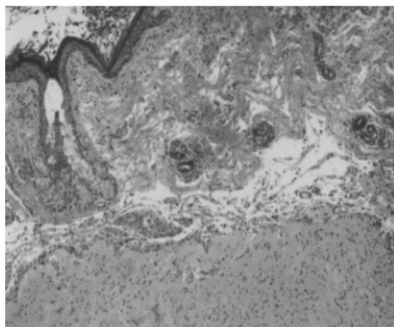 Fig. 2. Laparoscopic finding, indicating inci- inci-sion of the ovarian capsule and blunt  dissection.