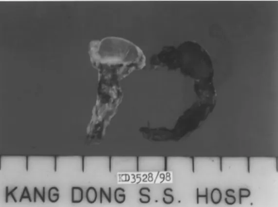 Fig. 4. Both testes, which are small,  measuring 1.5x1x1cm with yellowish-brown granular cut surface and attached  sper-matic cord.