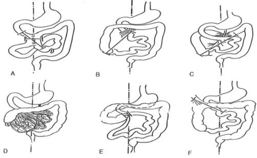 Fig. 3.  장회전  이상을  동반한  좌하복부  급성  충수염 쪽에  위치하였고(그림  1),  상  장간막  동맥이  정맥보다  오른쪽으로  치우쳐  있었다(그림  2)