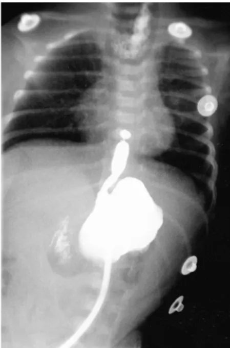 Fig. 1. Infantogram shows coiled-up radi- radi-oopaque catheter at the level of T-3  verte-bra and airless abdomen