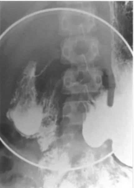 Fig. 3. Upper gastrointestinal series with  barium reveals a round intraluminal lesion,  filled with contrast medium and surrounded  by a radiolucent halo in the second  por-tion of the duodenum