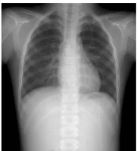 Fig.  6.  Chest  PA  at  the  3rd  postoperative  day.  Trachea  is  returned  to  the  normal  position  with  disappearance  of  the  mediastinal  mass