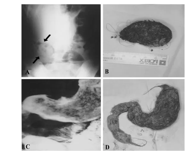 Fig.  1.  Presentation  of  the  case  1:  Plain  abdominal  X-ray  (A),  depicted  an  ovoid  mass  outlined  by  air  (arrows)  in  the  right  lower  quadrant  abdomen  and  multiple  air-fluid  levels;  The  trichobezoar  (8),  which  has  passed  thro