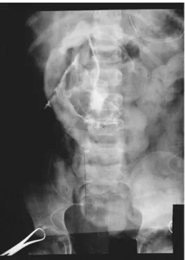 Fig.  1.  Intraoperative  cholangiogram,  showing  extravasa- extravasa-tion  of  the  contrast  from  the  transected  common  bile  duct