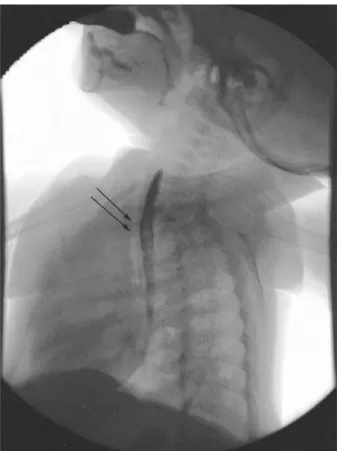 Fig.  1.  The  esophagography  is  showing  no  stricture  of  the  esophageal  anastomosis  and  recurrent  tracheoesophageal  fistula