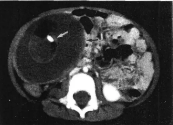 Fig.  1.  Abdominal  computerized  tomography  of  a  cysti c  mass(black  arrow),  6 x 8 x 9 cm,  with  inhomogeneous  solid  component  of  fat  and  calcification(white  arrow)  in  the  right  subhepatic  area 