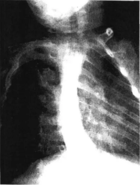 Fig.  2.  An  esophagogram  which  shows  reflux  to  cervical  esophagus  and  hiatal  hernia