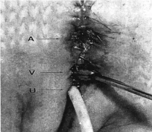Fig.  3.  The  perineum  after  complete  reconstruction  (case  3).  U;  new  urethral  opening,  V;  new  vaginal  opening,  A;  new  anus