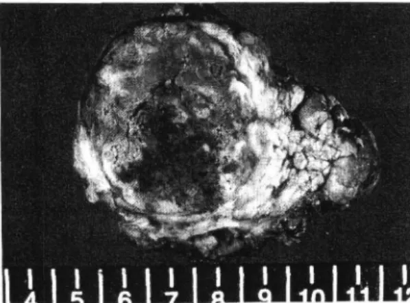 Fig.  1.  Abdominal  computerized  tomogram  of  the  case  1,  showing  heterogeneous  low  attenuation  spherical  mass  in  the  pancreas  tail  without  invasion