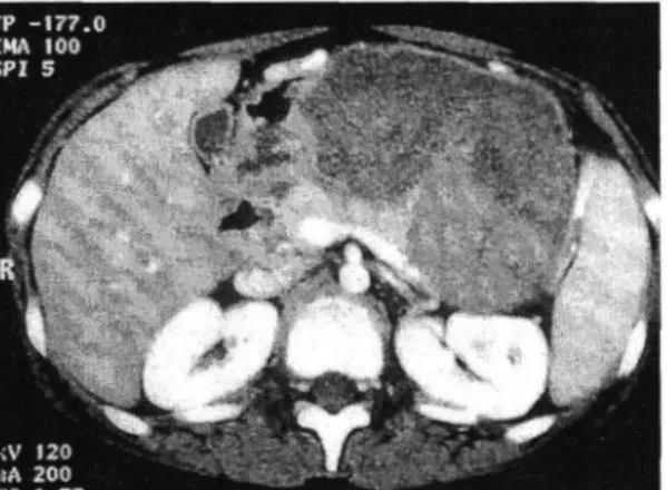Fig.  5.  Gross  fmding  of  the  resected  tumor  (Case  2). 