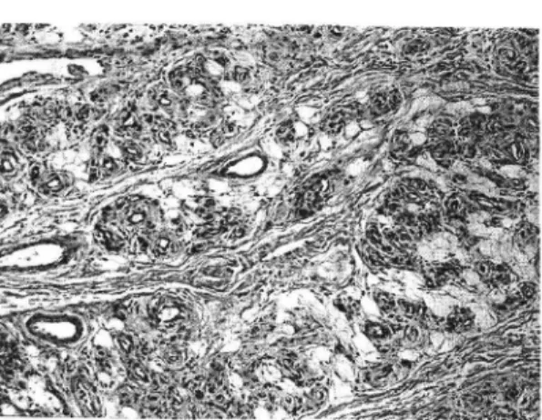 Fig  6.  Photomicrogram  of  the  Immunostaining  for  factor  VII-related  antigen,  showing  positive  reaction  in  endothelial  cells  (H&amp;E,  x 200)
