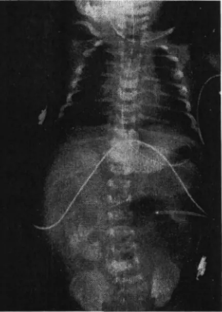 Fig.  1.  Preoperative  infantogram  on  the  day  of  birth,  showing  dilated  small  bowel  and  irregular  calcified  shadow  at  RL  abdomen