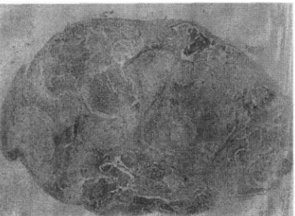 Fig.  2.  Microscopic  findings  of  the  brain  stem,  sho- sho-wing  cell  loss  and  degenerative  changes  in  the   nu-clei,  particularly  of  the  vagus,  hypoglossus,  and   soli-tary  nerves  and  tegmental  nuclei(H  &amp;  E,  x  400)
